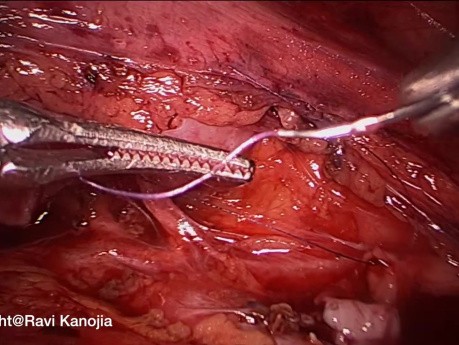 Retroperitoneoscopic Pyeloplasty