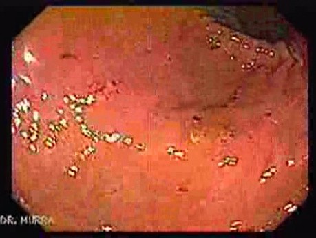 Percutaneous Endoscopic Gastrostomy - PEG (1 of 6)