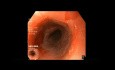Esophageal Tear During Upper Endoscopy