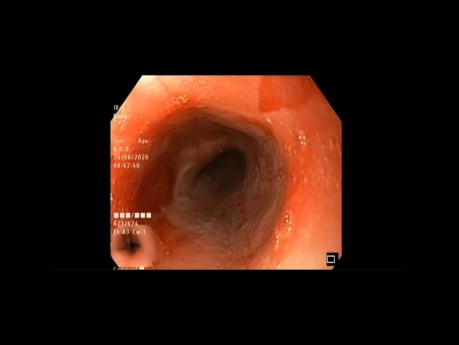 Esophageal Tear During Upper Endoscopy