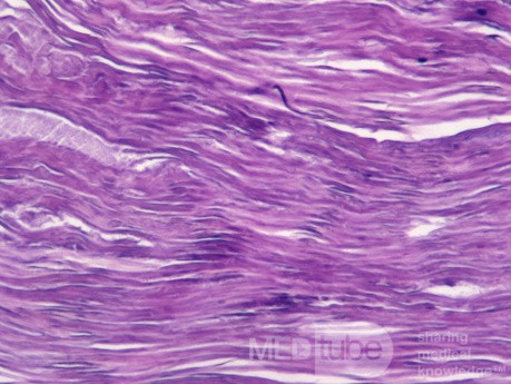 Membranous Otitis Externa [Histoology of Cast]