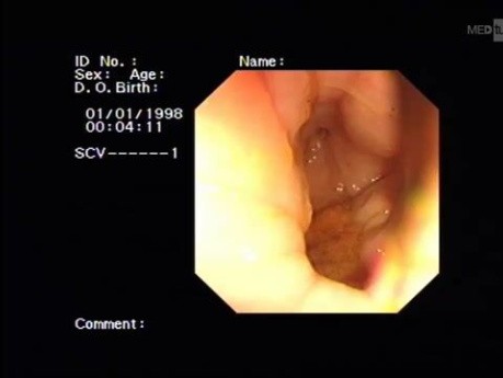 Vesicorectal Fistula
