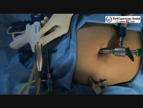 Laparoscopic Myomectomy for Posterior Wall Fibroid Uterus with Endometriosis
