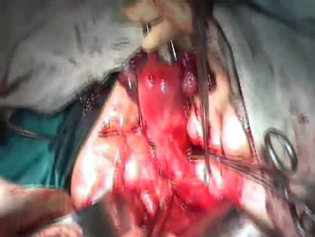 Radical Surgery of the Uterus - Ureteric Canal Dissection