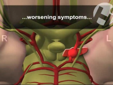 Aneurysm Leak