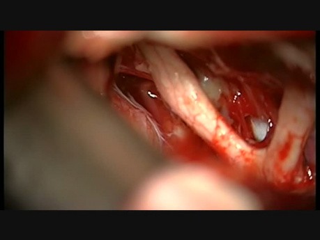 Left Ophthalmic ICA Aneurysm Approached from Right