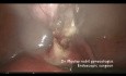 How to make simple complex myomectomy