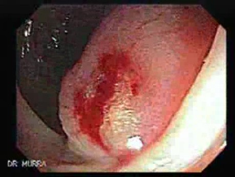 Colonic Lipoma (3 of 3)