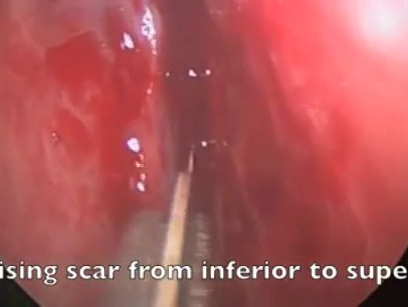 Massive Scarring In The Nasal Cavity - FESS