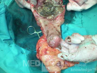 Non-Hodgkin's Lymphoma of the Colon (9 of 16)
