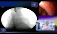 Advanced Pulmonary Neoplasia with Esophageal Compression - One Stent, Two Problems