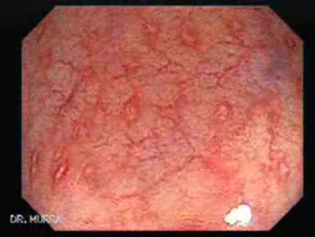 Crohn´s Colitis (1 of 3)