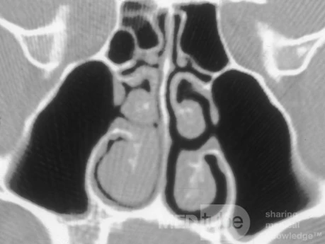Accessory Maxillary Sinus Ostium [CT scan]