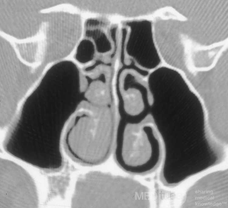 Accessory Maxillary Sinus Ostium [CT scan]
