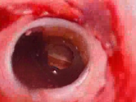 Colonic Perforation With Peritonitis - Laparoscopy (9 of 46)