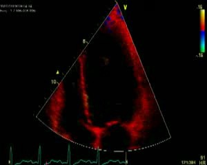 Dyssynchrony In Cardiac Echo