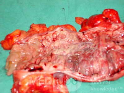 Severe case of Ischemic Colitis (18 of 19)