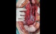 Great Vessels Anatomical Variation