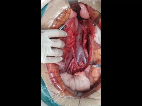 Great Vessels Anatomical Variation