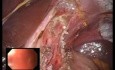 Laparo-Endoscopic Single Site (LESS) Heller Myotomy & Anterior Fundoplication