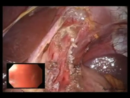 Laparo-Endoscopic Single Site (LESS) Heller Myotomy & Anterior Fundoplication