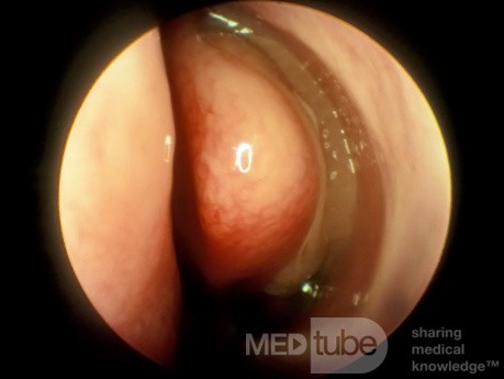 Concha Bullosa with Polypoid Degeneration Lateral Surface [left]