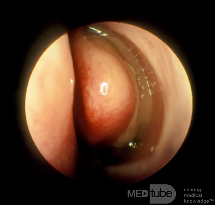 Concha Bullosa with Polypoid Degeneration Lateral Surface [left]