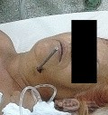 Spinal cord injury from spearfishing harpoon