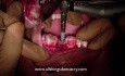 Computer Aided Implant Surgery - Placing The Implant - Finally
