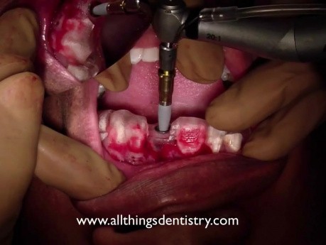 Computer Aided Implant Surgery - Placing The Implant - Finally