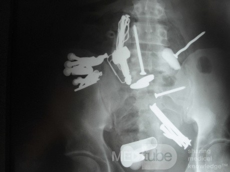 Multiple Foreign bodies in the GI tract (6 of 12)