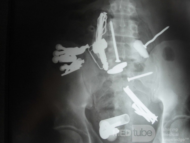 Multiple Foreign bodies in the GI tract (6 of 12)