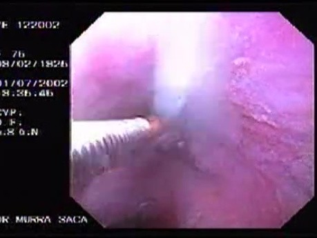 Hemorrhage due status post rubber band ligation of esophageal varices (15 of 25)