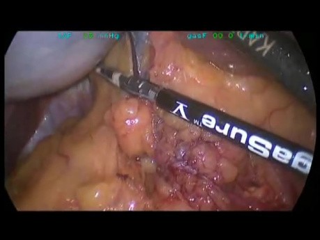 Partial Spleen Resection With A Laparoscipic Approach Due To A Cyst Presence  