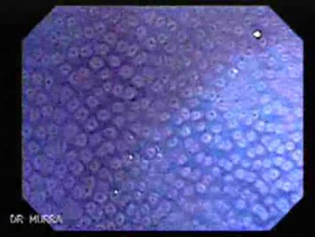 Non Familial Juvenile Polyposis Of The Colon (25 of 37)