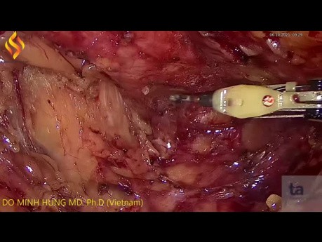 LAR for Huge Rectal Cancer