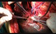 Parenchyma Sparing Hepatectomy with Portal Vein Reconstruction