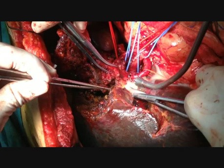 Parenchyma Sparing Hepatectomy with Portal Vein Reconstruction