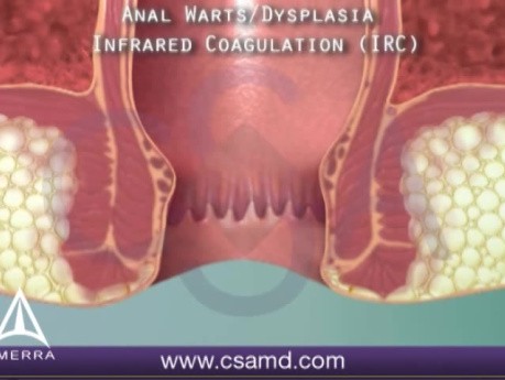 Anal Warts - 3D Medical Animation