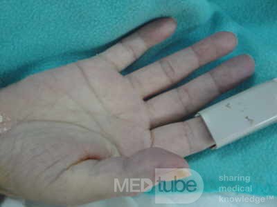Multiple Rectal Ulcers (34 of 110)
