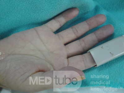 Multiple Rectal Ulcers (34 of 110)