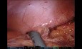 Total Robotic Utero-Sigmoid-Coloneo-Vaginoplasty Restoring Sexual and Fertility Function