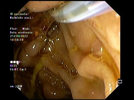 Purulent cholangitis
