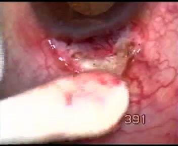 Neovascular glaucoma - operation
