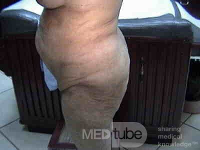 Extensive Acanthosis Nigricans due to rectal carcinoma (6 of 7)