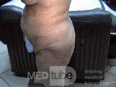Extensive Acanthosis Nigricans due to rectal carcinoma (6 of 7)