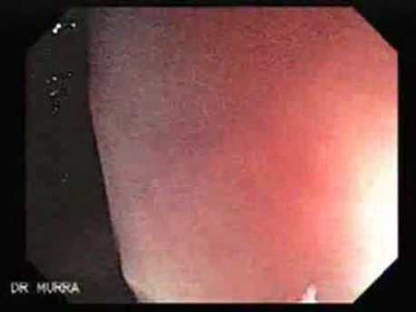 Diffuse Colonic Varices (1 of 4)