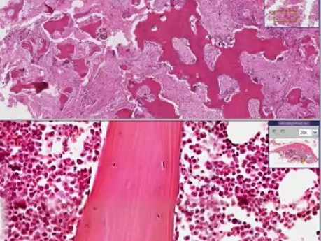 Paget disease - Histopathology