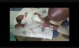 How I do the Ponseti Method for Clubfoot Deformity