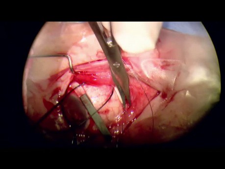 25g PPV - Encircling Scleral Buckle for Multiple Holes Retinal Detachment